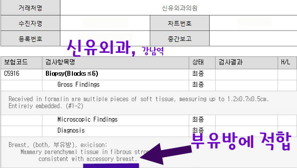 부유방제거수술전후사진. 1년후 모습까지도. 