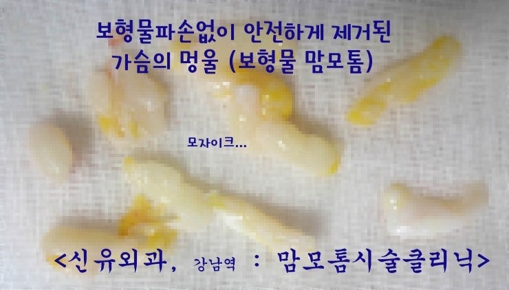 가슴보형물과 멍울 사이 거리가 0.2cm인 상태: 안전하게 맘모톰시술 받으신 분