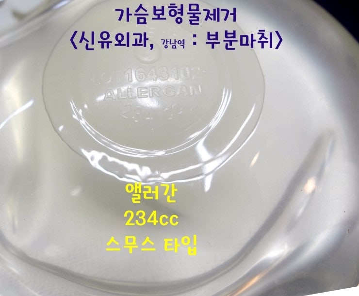 6년만에 유륜주위절개 약 2~2.5cm으로 스무스 코헤시브겔 제거하신 분. (부분마취, 테이프로 봉합)