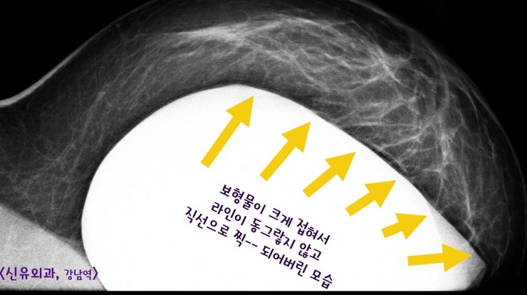 접힌 보형물제거하고, 처진가슴 유방하수 거상술을 동시에 부분마취로 한 경우. 
