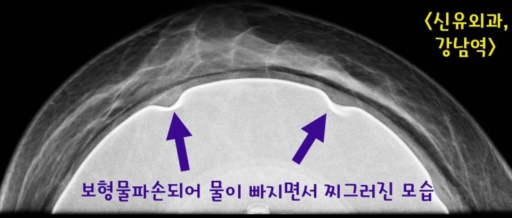 가슴보형물파손되어 부분마취로 제거후 바로 코젤스무스 200cc로 교체한 분 ; 보형물교체