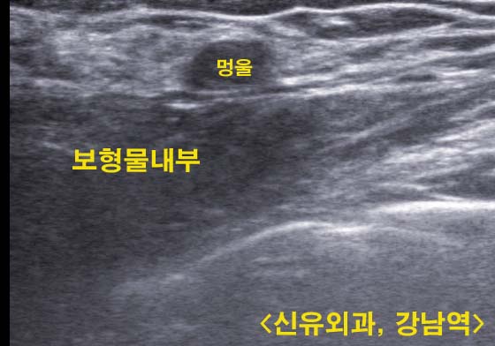 파손된 가슴보형물을 감싼 포켓을 손상시키지 않고 유방멍울을 맘모톰시술로 제거한 케이스.