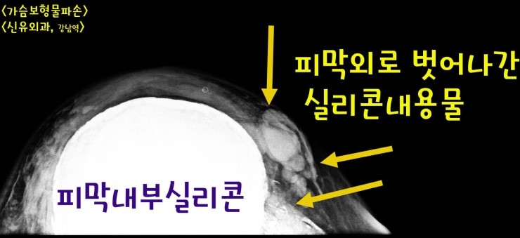 옛날 실리콘 가슴보형물 피막외파손으로 내용물이 복부근육을 따라 퍼져 있었던 분