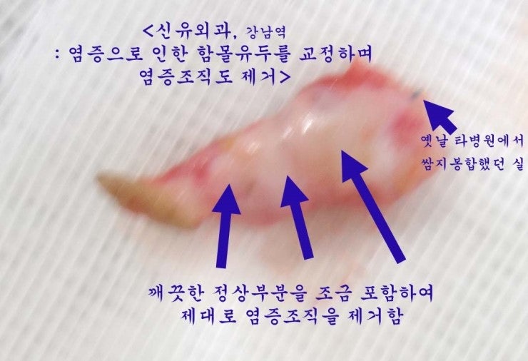함몰유두가 비수유기 유륜주위유선염과 연결되어 염증의 누공(fistula)까지 한번에 제거하면서 함몰유두교정수술 시행. 