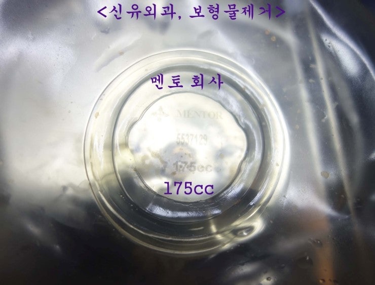 2007년 생리식염수백가슴보형물하신후 파손되어 부분마취로 1cm절개하여 50분만에 제거하신 분
