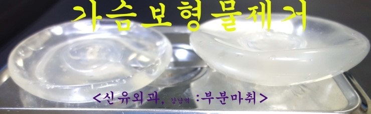 가슴보형물제거수술전후사진. 12년동안 유지한 후의 모습.