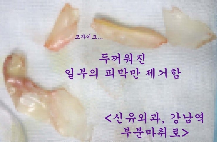 피막을 일부 제거하고 스무스로 가슴보형물교체