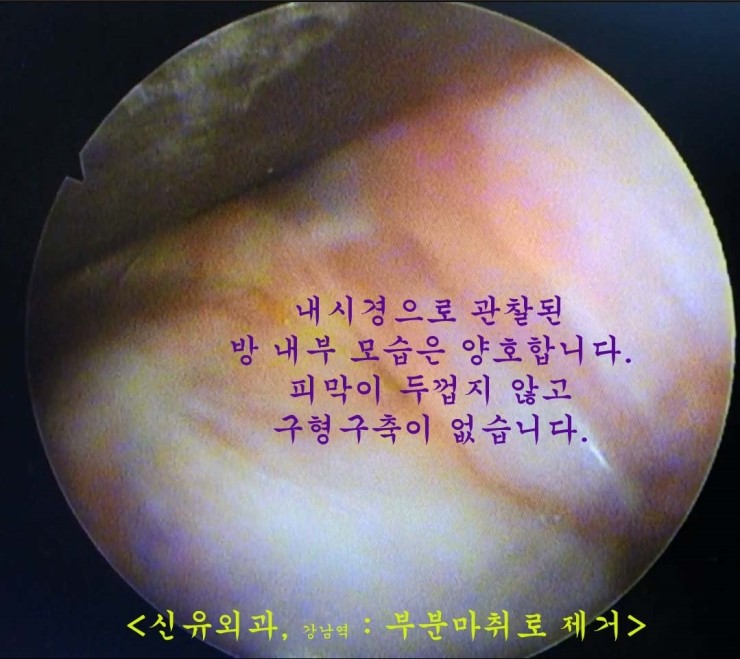 가슴보형물을 부분마취로 겨드랑이절개하여 제거