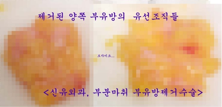 부유방제거수술전후사진 ; 리얼