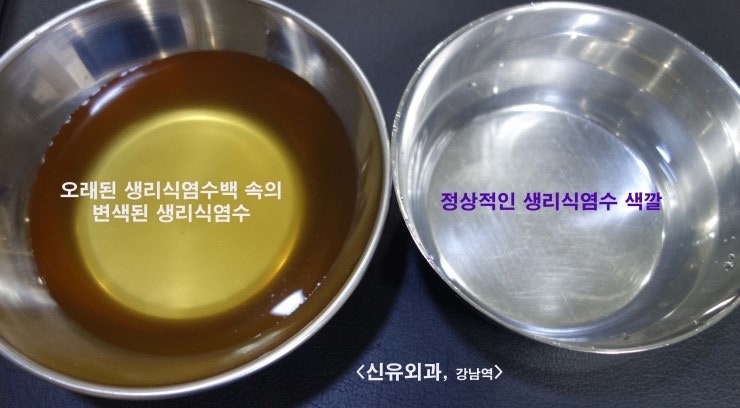 1.5cm 유륜절개로 가슴보형물제거수술 : 생리식염수가 변색된 모습 