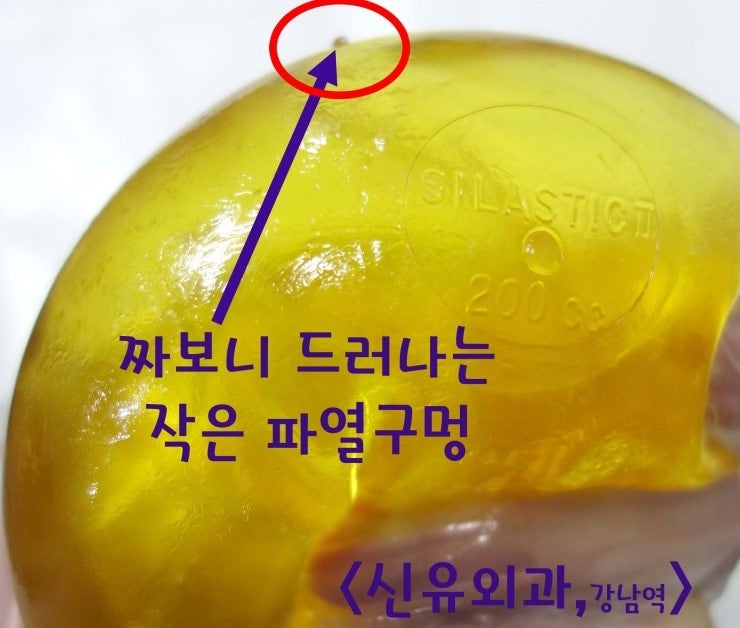 28년전의 옛날 실리콘가슴보형물이 양쪽 다 파손되었으나 대학병원에서 괜찮다고 들으신 호주에서 오신 분