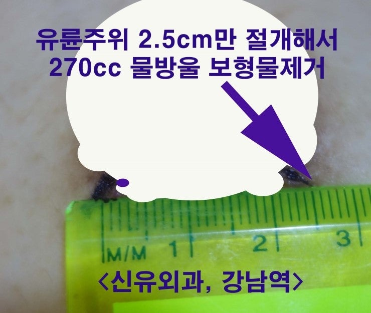 270cc 보형물제거수술을 2.5cm 유륜절개 부분마취로 :내시경상 갈비뼈와 근육이 비쳐보일 정도로 피막이 얇으셨던 분