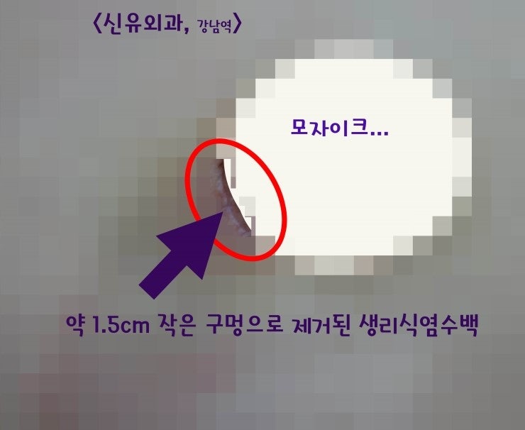 10년만에 생리식염수백이 뒤집혀서 불편해서 제거하신 분.(1.5cm 절개로 부분마취만으로.)
