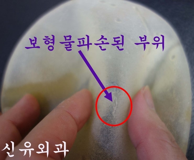 2002년 생리식염수백이 파손되어 유륜주위 1.5cm 작은구멍으로 가슴보형물제거수술받으신 후기