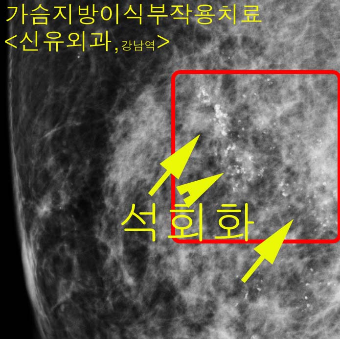 가슴자가지방이식부작용치료를 받으신 후 이제는 어깨가 아프지 않으시다는 후기