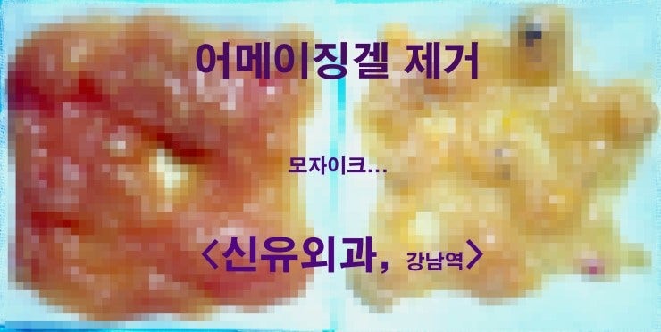 어메이징겔제거수술후기