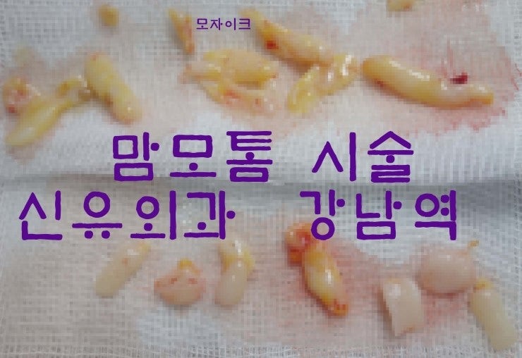 맘모톰수술후기(겨드랑이접근법)