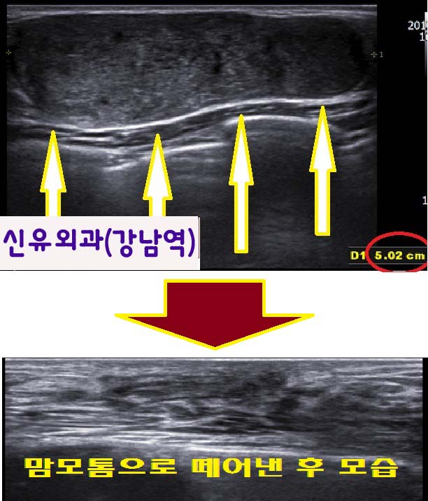 거대섬유선종도 맘모톰시술로 제거 가능