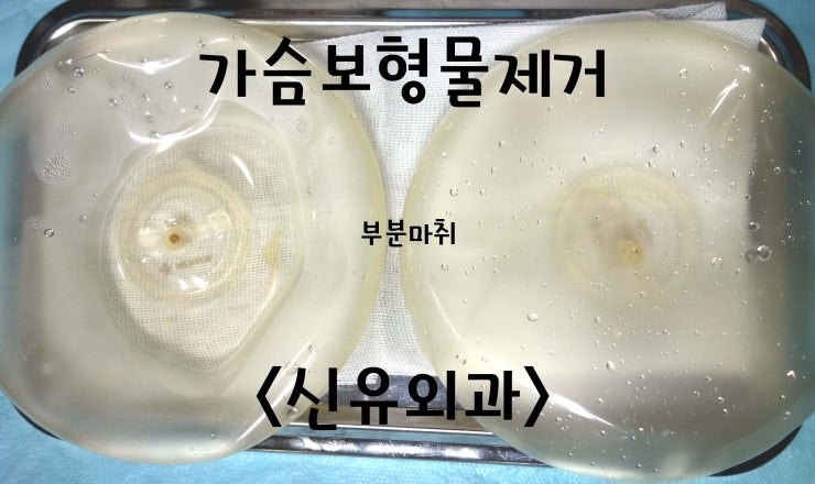 가슴보형물제거후 재삽입후기(스무스 코젤로 교체)