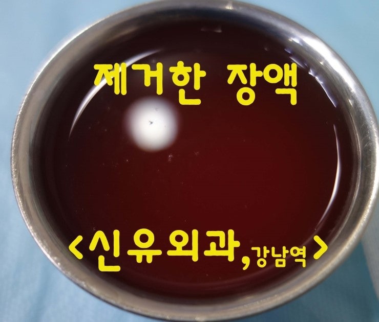부산에서 오신, 이중피막때문에 보형물제거, 교체 