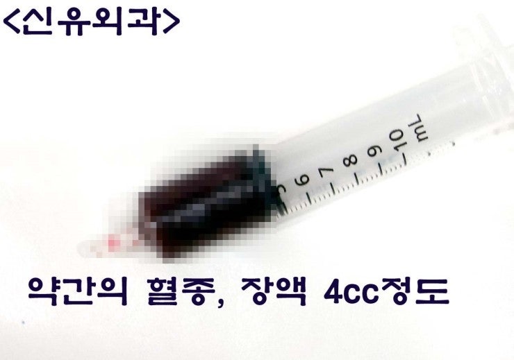 스무스가 불편해서 가슴보형물제거하러 오셨는데, 초음파상 접혀 있었던 분 후기