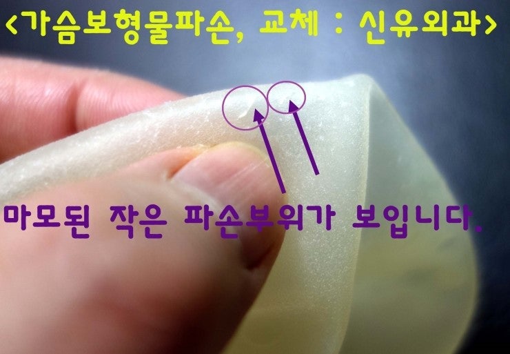 캐나다에서 가슴보형물파손으로 오신 분 교체 & 처진가슴거상술(올리기) = 헉!@ 이걸 부분마취로??? ^^ 넵!!!