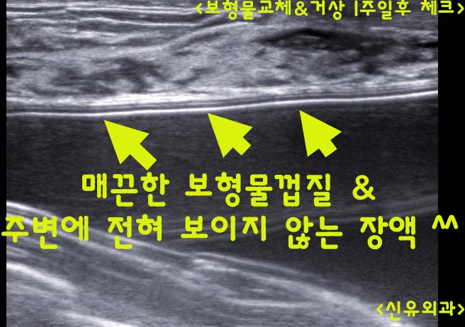 캐나다에서 보형물파손되어 오셔서 교체&처진가슴거상술 받으신 분의 "두 번째" 후기 
