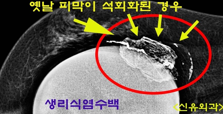 석회화된 피막제거술(calcified capsulectomy)