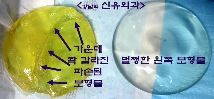 가슴보형물파손제거수술 & 처진가슴 거상술 --> 후기. 
