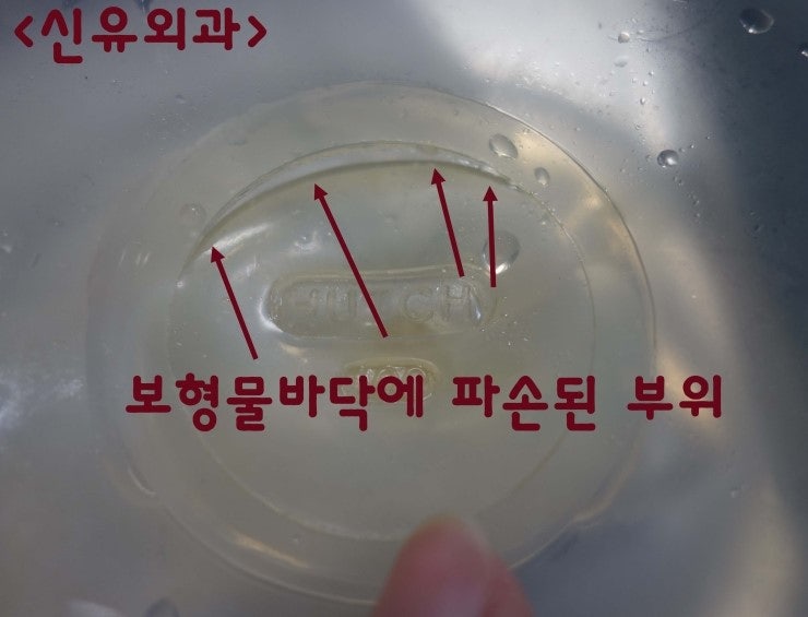 출산 100일된 애기 엄마, 가슴보형물파손으로 제거수술하며 맘모톰 동시 시행
