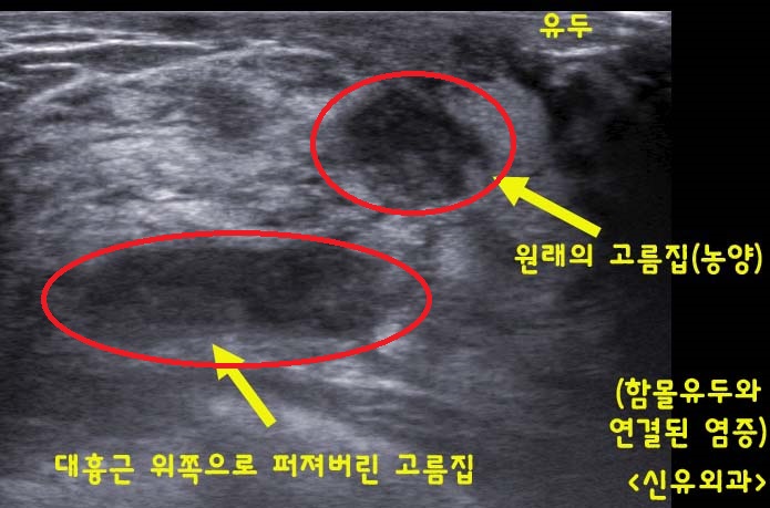 19세 함몰유두와 연결된 유선염 수술후기