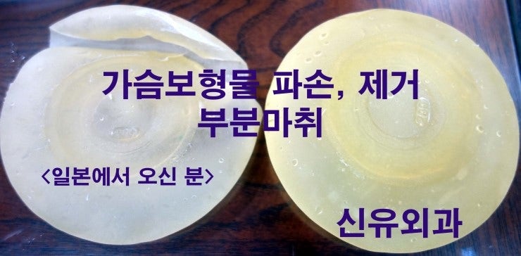 일본에서 오신, 두번째로 써 주신 "가슴보형물파손제거수술후기"