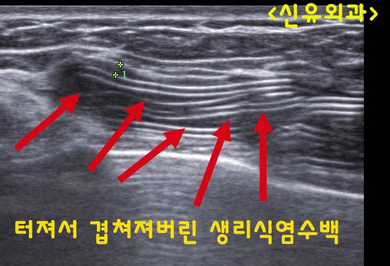 부분마취로, 9년만의 가슴보형물파손 --> 스무스로 교체 & (일부)피막제거까지 <대화 들림>