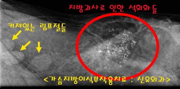 딱딱한 가슴지방이식부작용치료 3개월후, 보형물성형수술 성공적으로 받으신 분