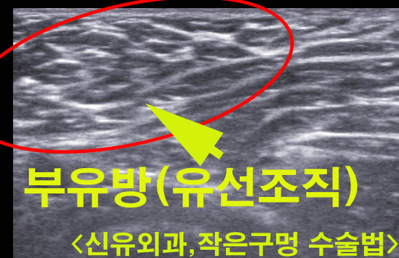 부유방수술전후사진과 수술중간 사진 ; 부분마취로. 
