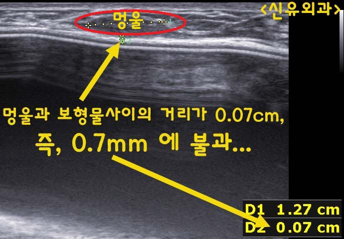 가슴성형 후에도 맘모톰으로 4개의 멍울을 안전하게 제거: 시술후기