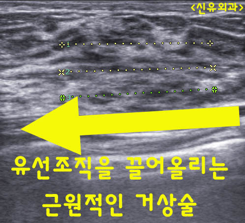 24살에 처진가슴 올리는 거상술(유선조직재배치법) 받으신 수술후기. : 부분마취로!!! 