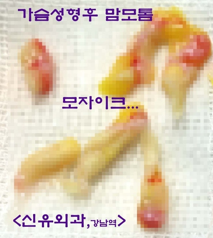 가슴성형 후 피막에 생긴 멍울: 타 유방외과에서 의뢰되어 부분마취, 맘모톰으로 제거한 수술후기
