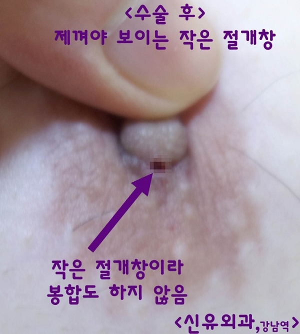 4시간 버스타고 오셨는데...30분 만에 끝난 남자 함몰유두수술 후기