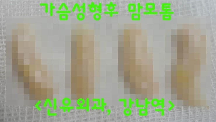 가슴성형후 맘모톰수술후기