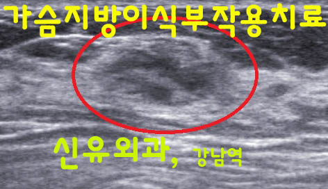가슴지방이식부작용 멍울이 만져져서 산부인과선생님으로부터 의뢰된 환자분 근육 속 처박힌 병변까지도 제거