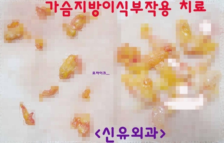 줄기세포prp가슴자가지방이식성형수술후 넓게 피부가 딱딱해져서 오신 분 후기