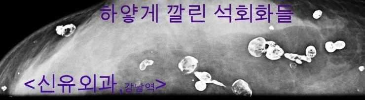 10년전 가슴지방이식성형수술후 단단하게 만져지는 멍울들 제거하러 오신 분 후기 