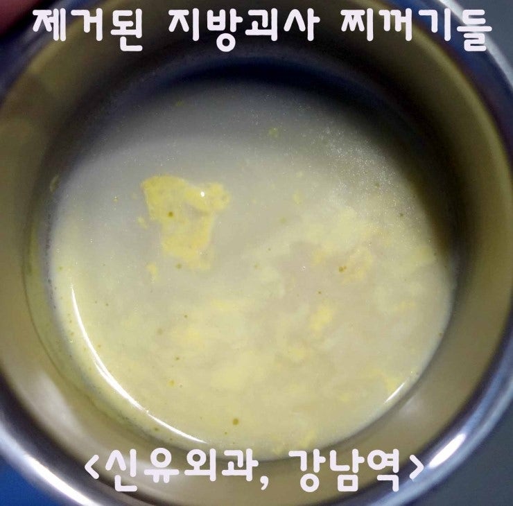 성형외과에서 의뢰되어 오신 가슴지방이식부작용치료 환자분 수술후기.