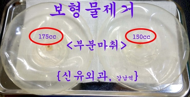 13년전 생리식염수백 가슴성형하셨는데 "신유외과 초음파 유도하 부분마취"로 간단히 제거 수술 받으신 분 후기 