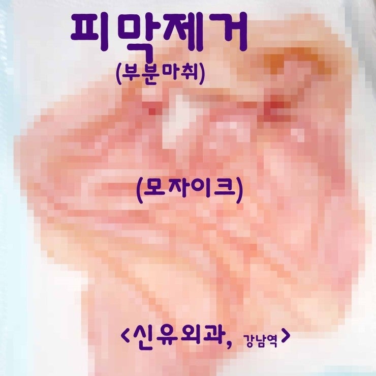 부분마취로 피막제거술을 했던 가슴보형물제거수술후기 (& 처진가슴 올리는 거상술까지 동시에)