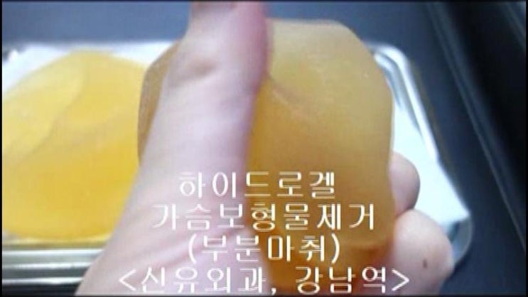 14년전 하이드로겔로 가슴성형수술하신 분, 부분마취로 제거후기 :구겨진 후 잘 펴지지 않는 모습