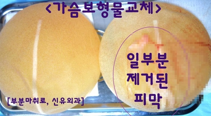 구형구축생겼고, 물방울보형물 회전해서, 스무스로 교체수술해 드리고, 피막 일부 제거했던 분
