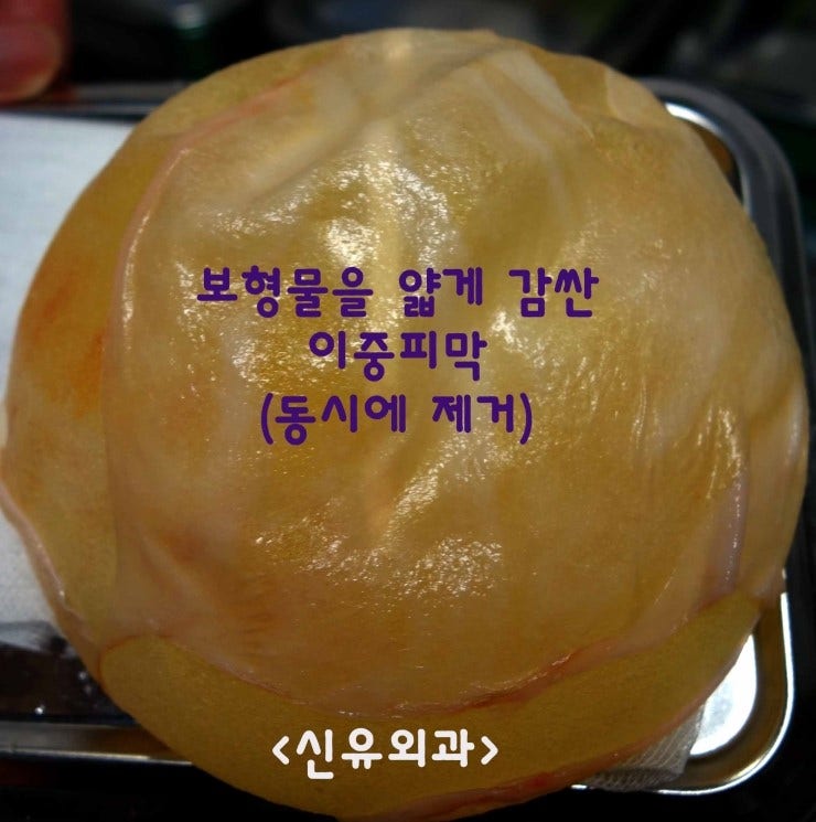 이중피막을 부분마취로 제거하고 물방울보형물파손을 스무스로 교체해 드린 분