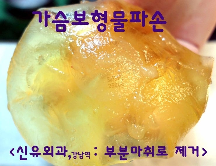 대학병원에서 발견 안 되었던 가슴보형물파손제거와 피막제거수술을 했는데, 혈종과 장액 생겨 치료해드린 분.